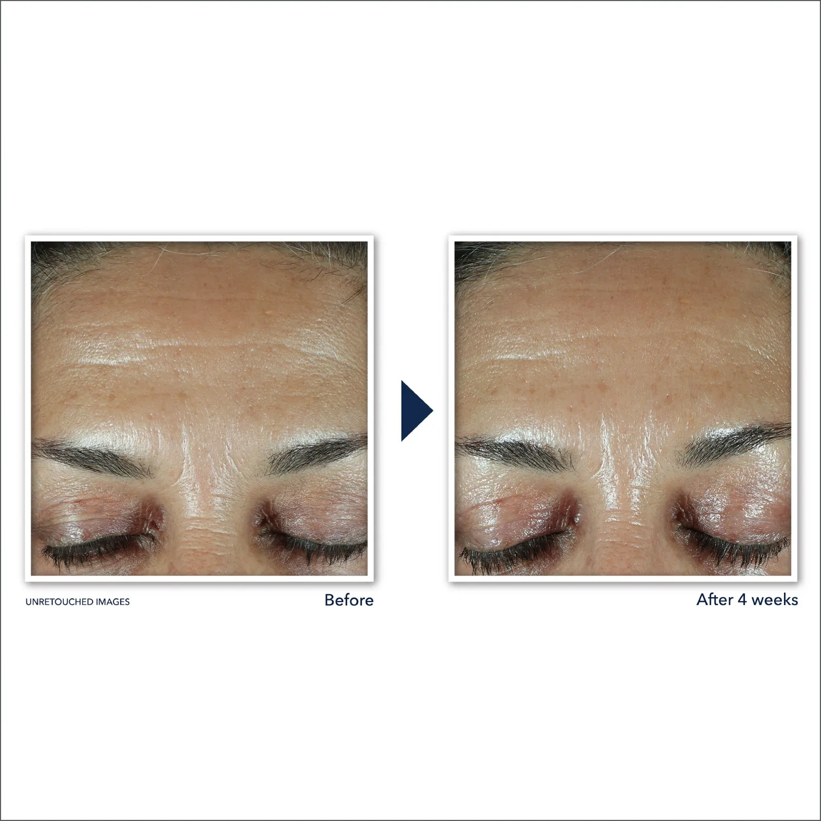 RETINOL CORREXION® Deep Wrinkle Filler